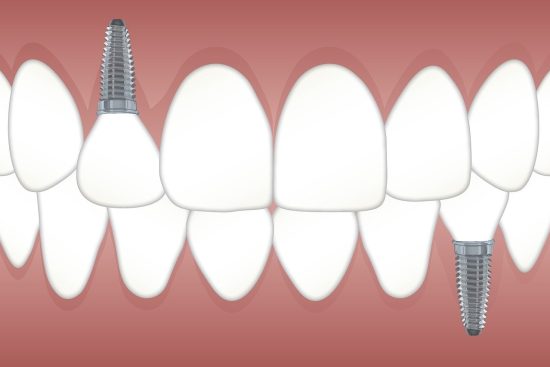 découvrez comment les implants rétiniens peuvent redonner une partie de la vision aux personnes atteintes de cécité ou de maladies dégénératives de la rétine grâce aux dernières avancées en technologie médicale.